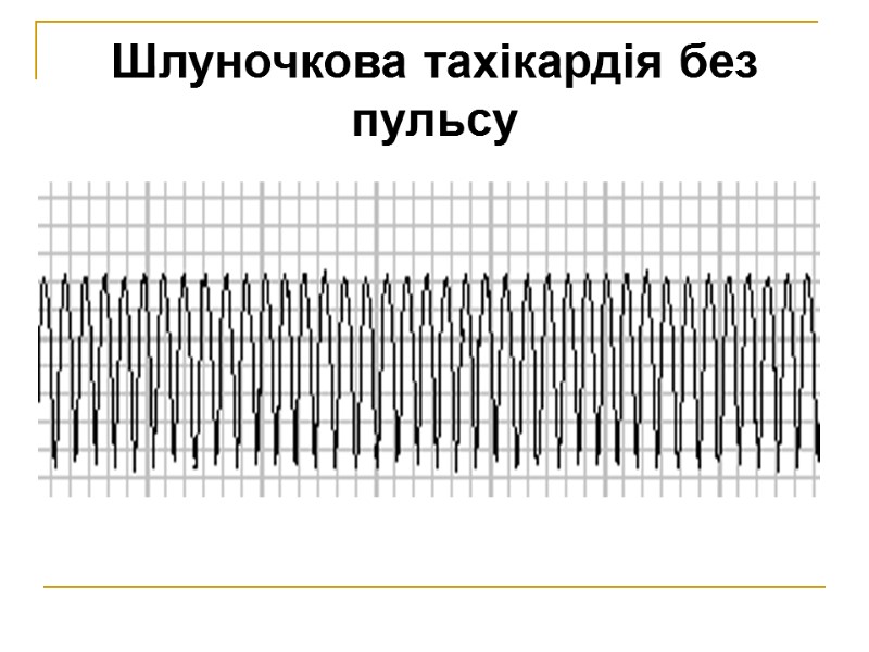 Шлуночкова тахікардія без пульсу